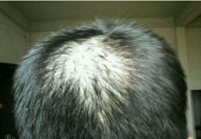 头顶O型脱发的病因是什么