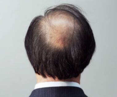 脱发的预防工作如何做?